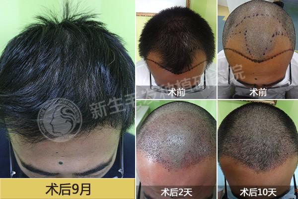 女性头发移植后赚钱机会有多大移植效果能持久吗