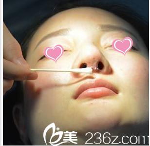为何我选择了卡盟鼻隆鼻效果怎样呢