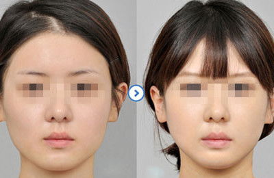 瘦脸针注射能否成为高收益项目？真相究竟如何？