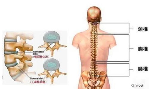 谷村奇草真的能治疗腰间盘突出吗？它的疗效是否如传说中那样神奇？